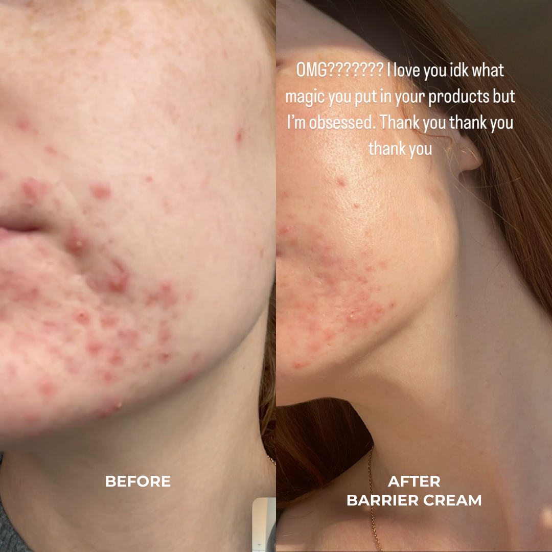 BARRIER CREAM: Ceramides + Blueberry