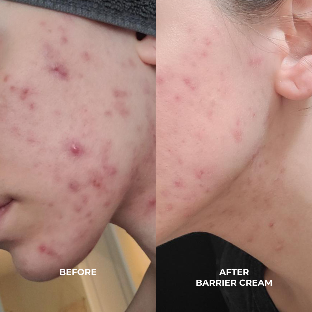 BARRIER CREAM: Ceramides + Blueberry