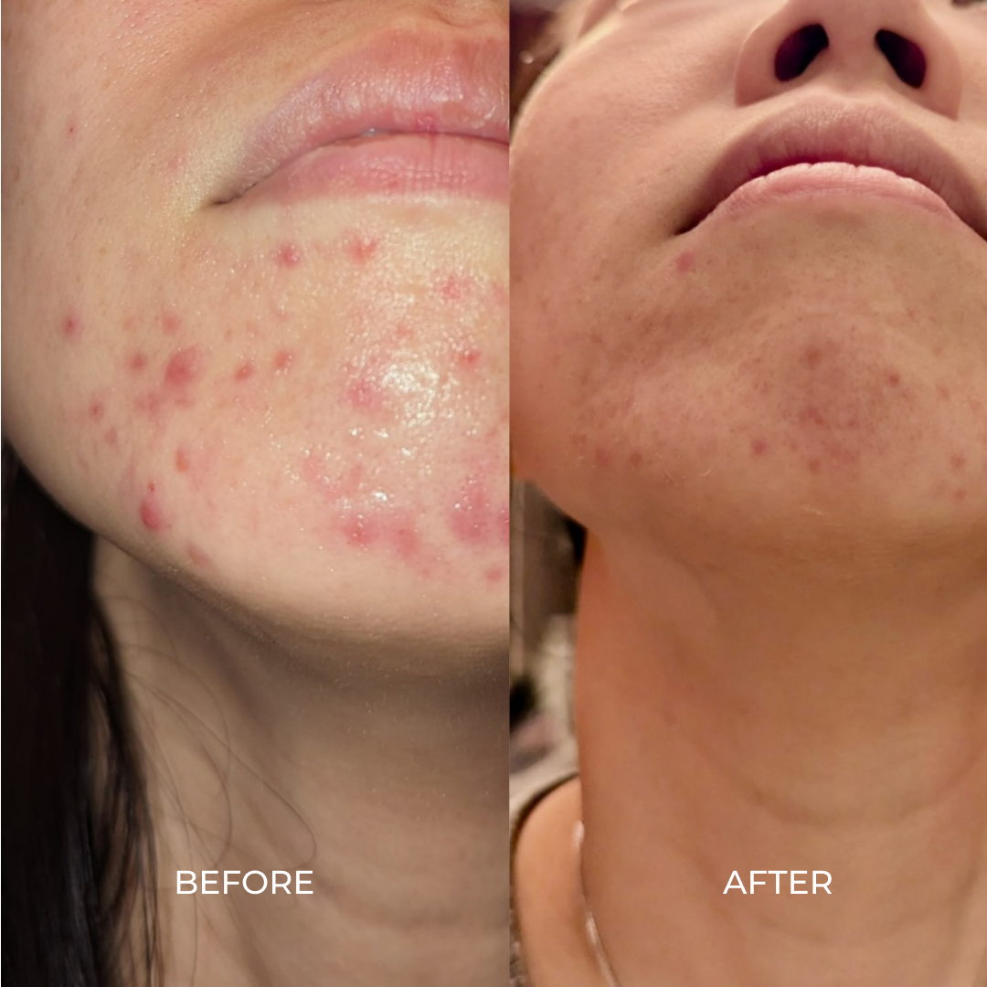 ACNE AND OILY PRONE SKIN - SAMPLER SET