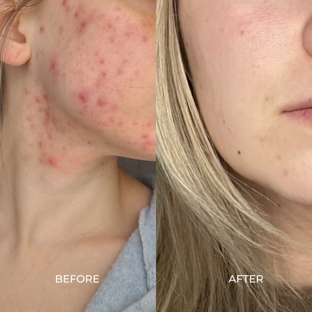 ACNE AND OILY PRONE SKIN - SAMPLER SET
