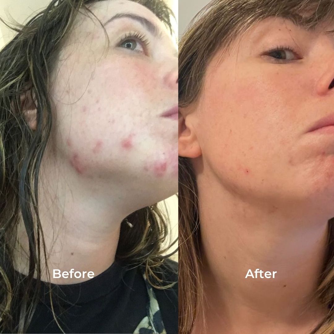 ACNE CONTROL